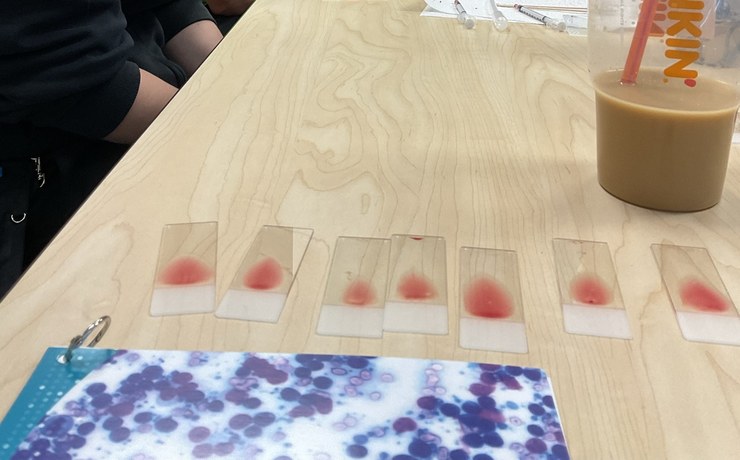 Blood smear slides lined up on a lab table next to a stained microscope image